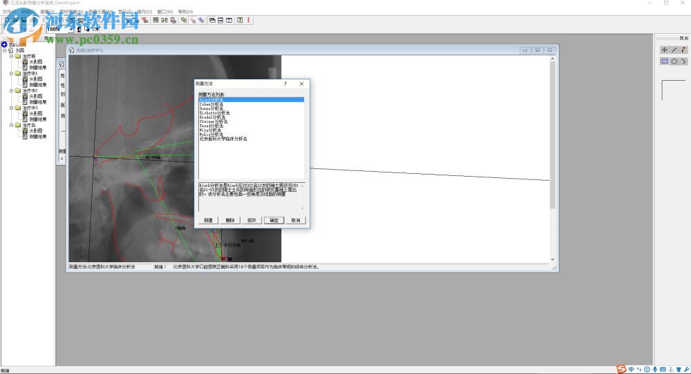 艾坚头影测量分析系统下载(DentiExpert) 2.2 官方版